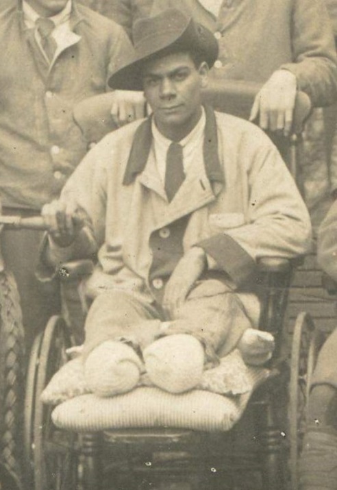 DOUBLE AMPUTEE AIF HORTON WAR HOSPITAL 2